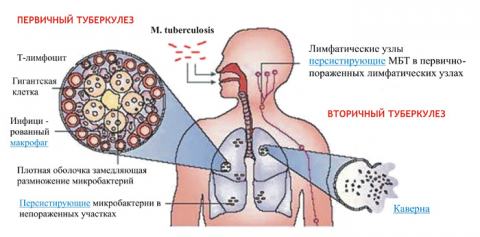 Схема начальных стадий туберкулеза
