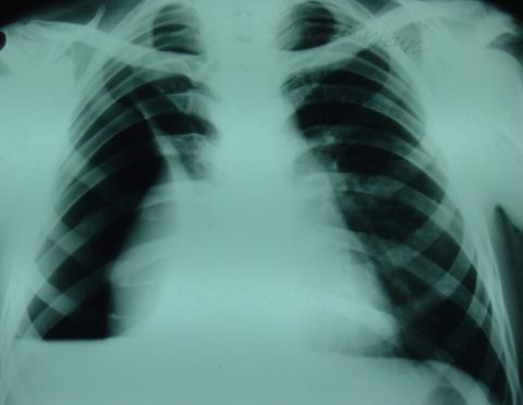 Затемнение на рентгенограмме – эмпиема плевры (плеврит)