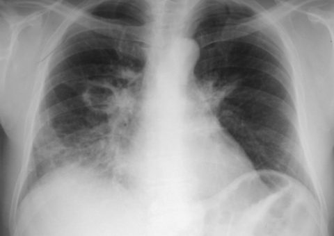 Затемнение в легких на рентгеновском фото